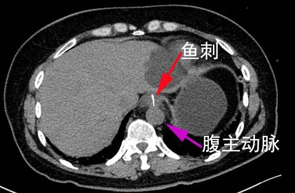 惊险！一碗鱼汤差点要了她的命！