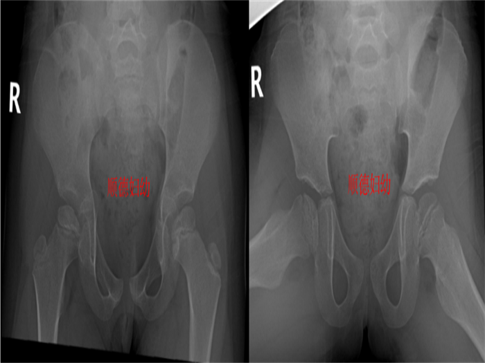 女孩股骨头坏死走路跛行，医生提醒这件事要趁早