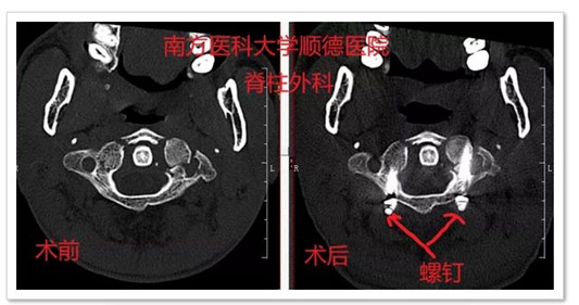 7米高空掉落，头先着地，能否逃此大难？