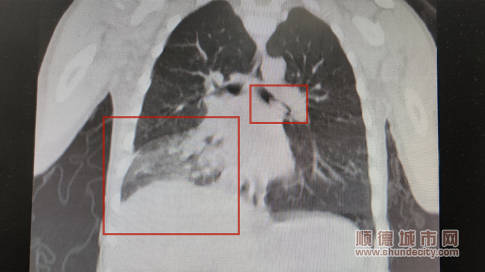 孩子肺部左侧气管里存在异物，右下肺出现实变.jpg