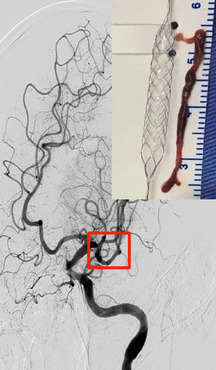 取栓后血管再通。.jpg