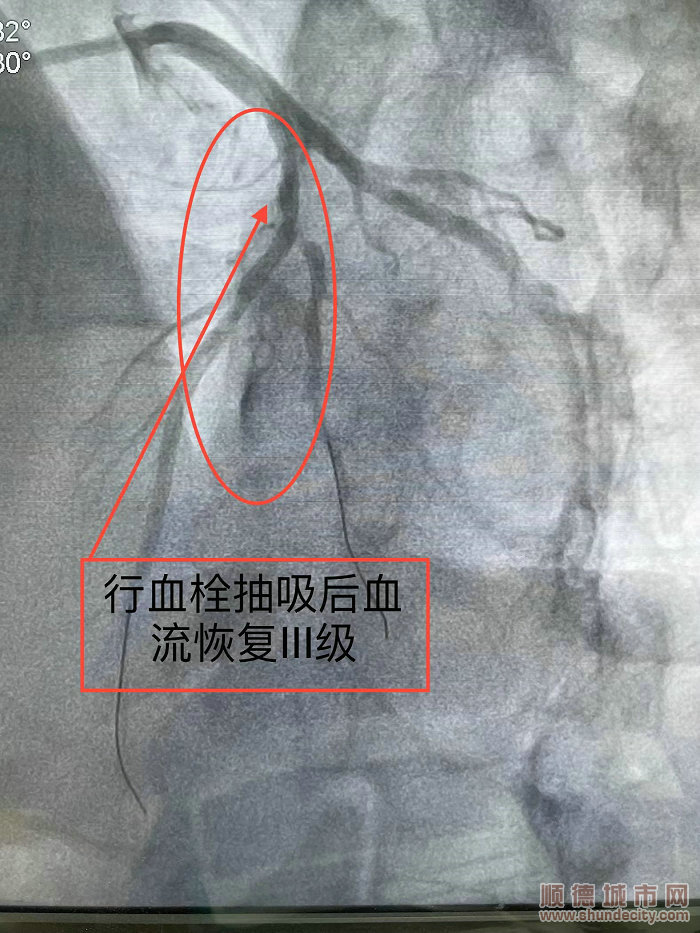 5经过及时治疗，患者血管开通了。.jpg