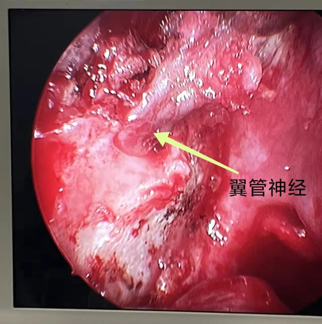 术中鼻内镜下显示右侧鼻腔翼管位置.jpg