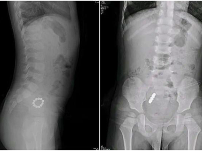 患儿误吞造成肠穿孔！这个正在流行的小玩具家长要注意了